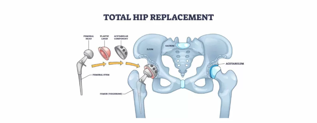 Hip Replacement Rehab in Pennsylvania